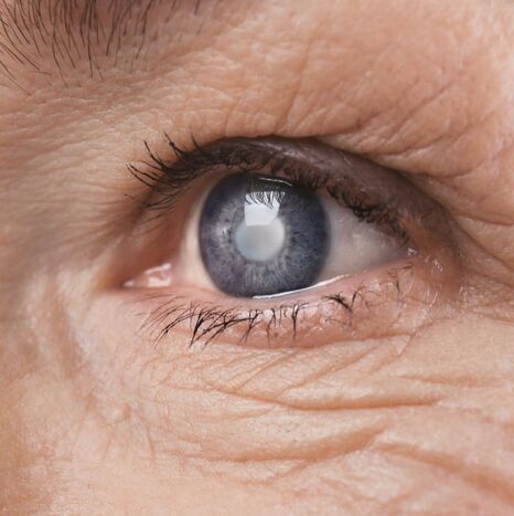 Cataract Eye Condition specialist in the UK