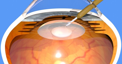 Performing cataract surgery on the human eye