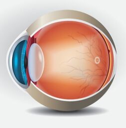 The human eye with cloudy lens for explaining cataract