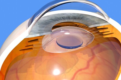 Human eye after successful cataract surgery
